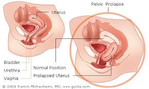 prolapsed uterus