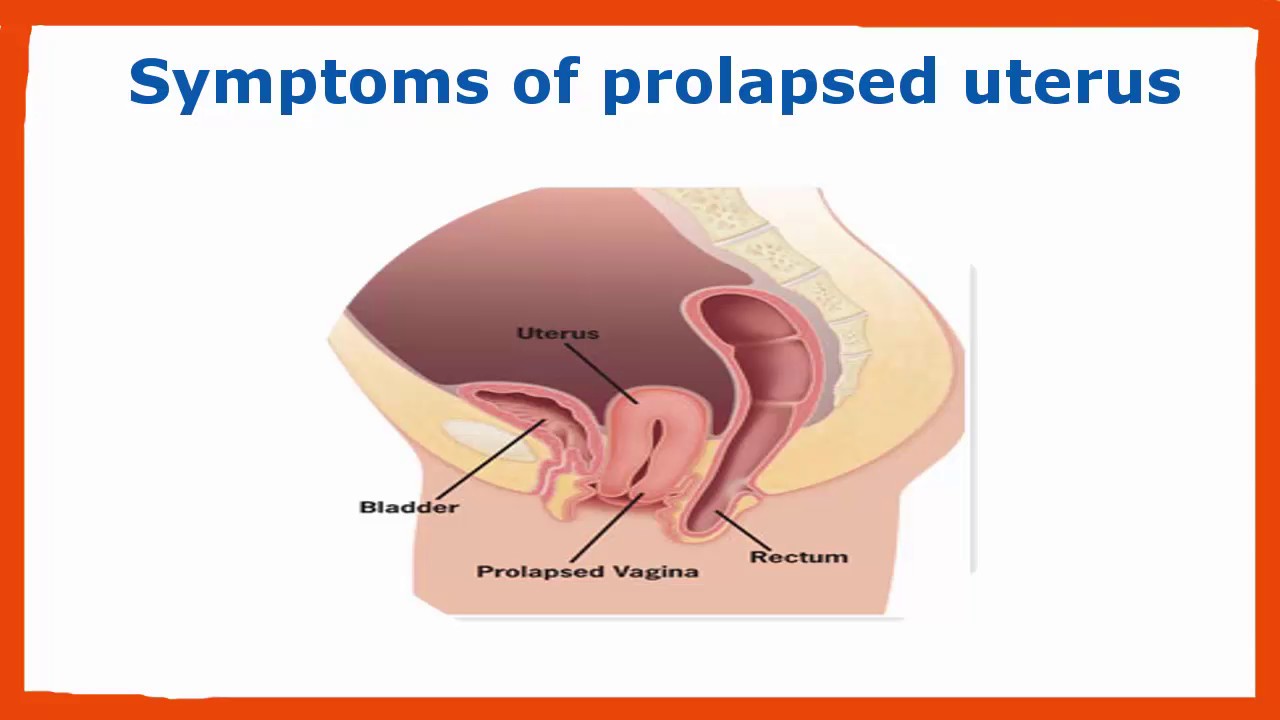 symptoms of uterus prolapse