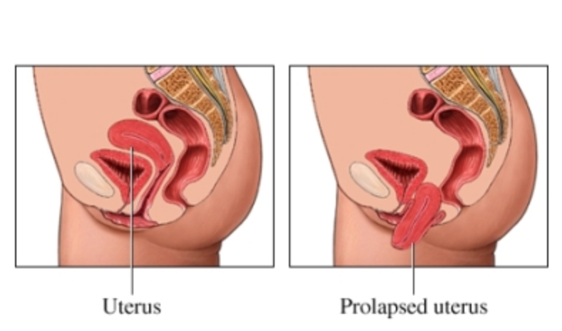 What happens if your uterus falls out