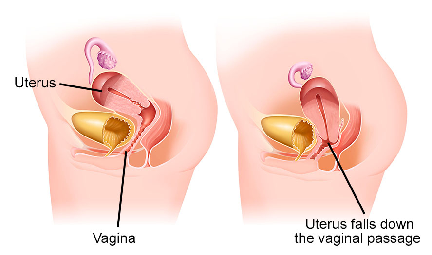 Does Prolapsed Uterus Go Back To Normal