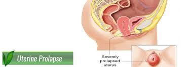 Uterus Prolapse Treatment