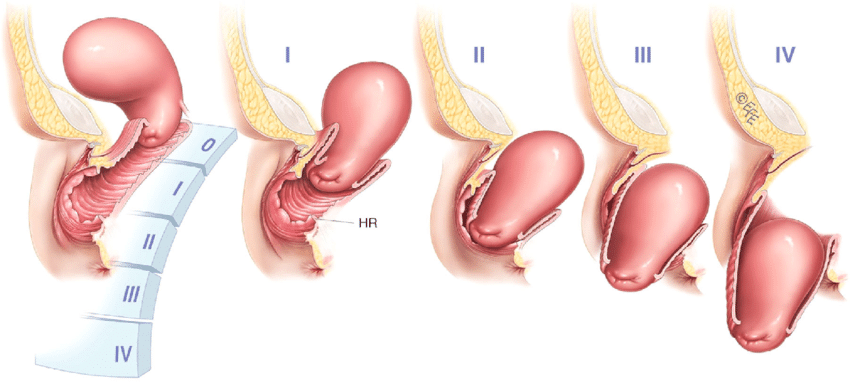 Can Uterine Prolapse Be Corrected Without Surgery