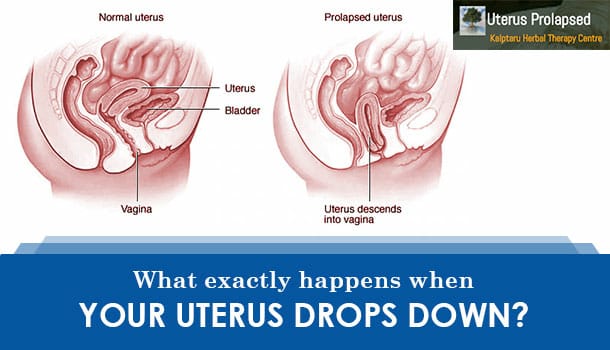 What Happens When Your Uterus Drops?