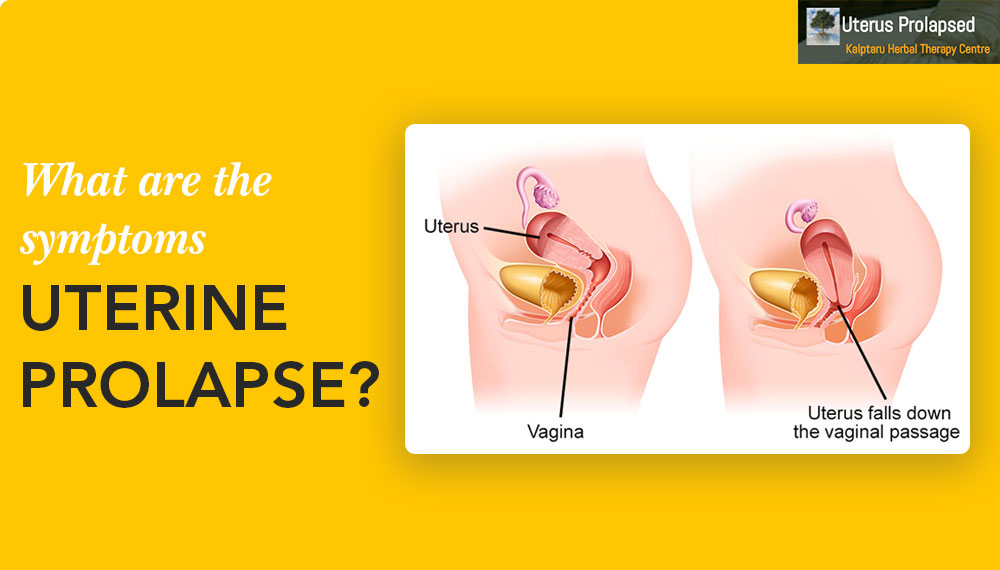 What Are The Symptoms Of Uterine Prolapse?