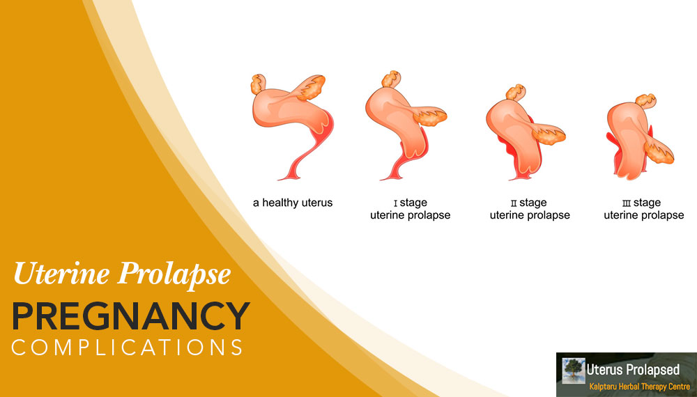 Uterine Prolapse Pregnancy Complications