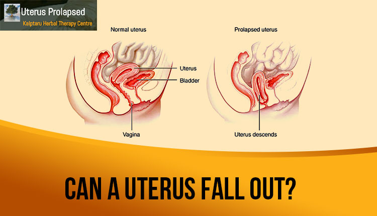 What Happens When Your Uterus Falls Out?