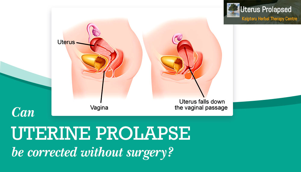 Can Uterine Prolapse Be Corrected Without Surgery?