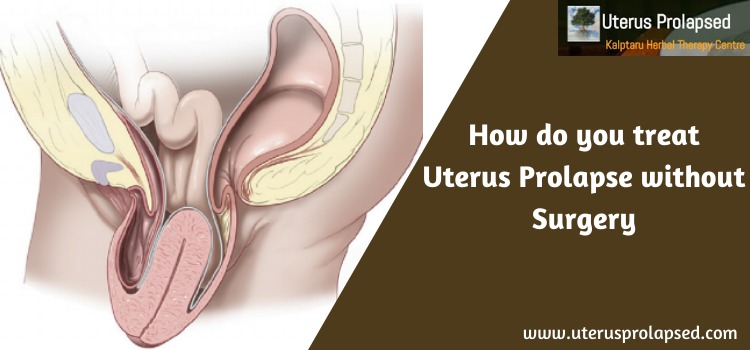 Uterus Prolapse without Surgery?