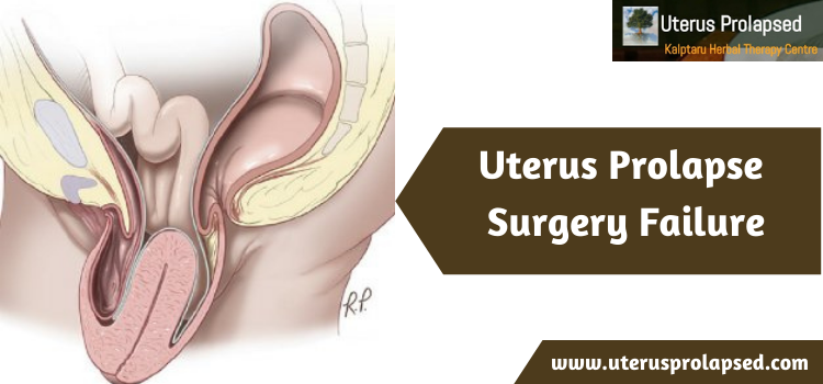 Uterus Prolapse Surgery Failure