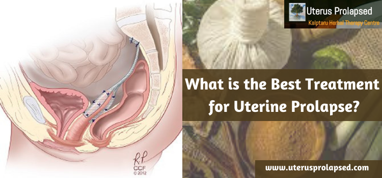 What Is The Best Treatment For Uterine Prolapse?