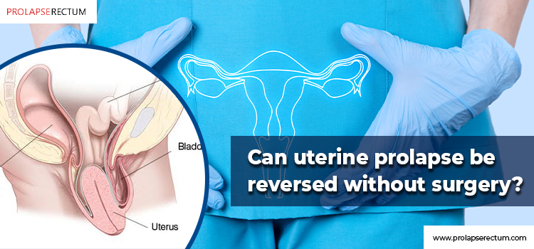 Uterine Prolapse Be Reversed Without Surgery