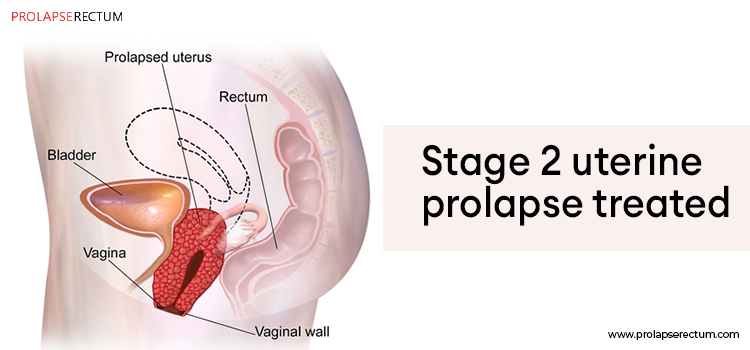 How Is Stage 2 Uterine Prolapse Treated?