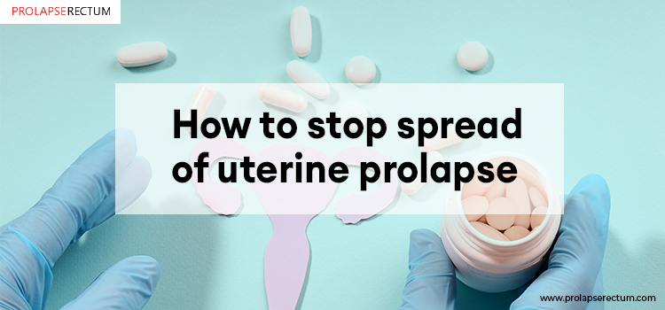 How To Stop Spread Of Uterine Prolapse?