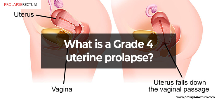 What Is A Grade 4 Uterine Prolapse?