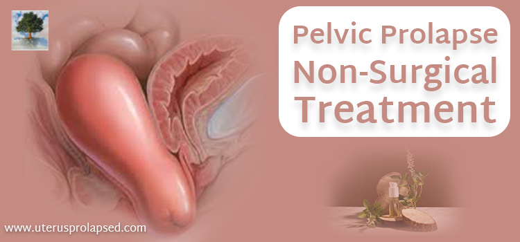 Pelvic Prolapse Non-Surgical Treatment