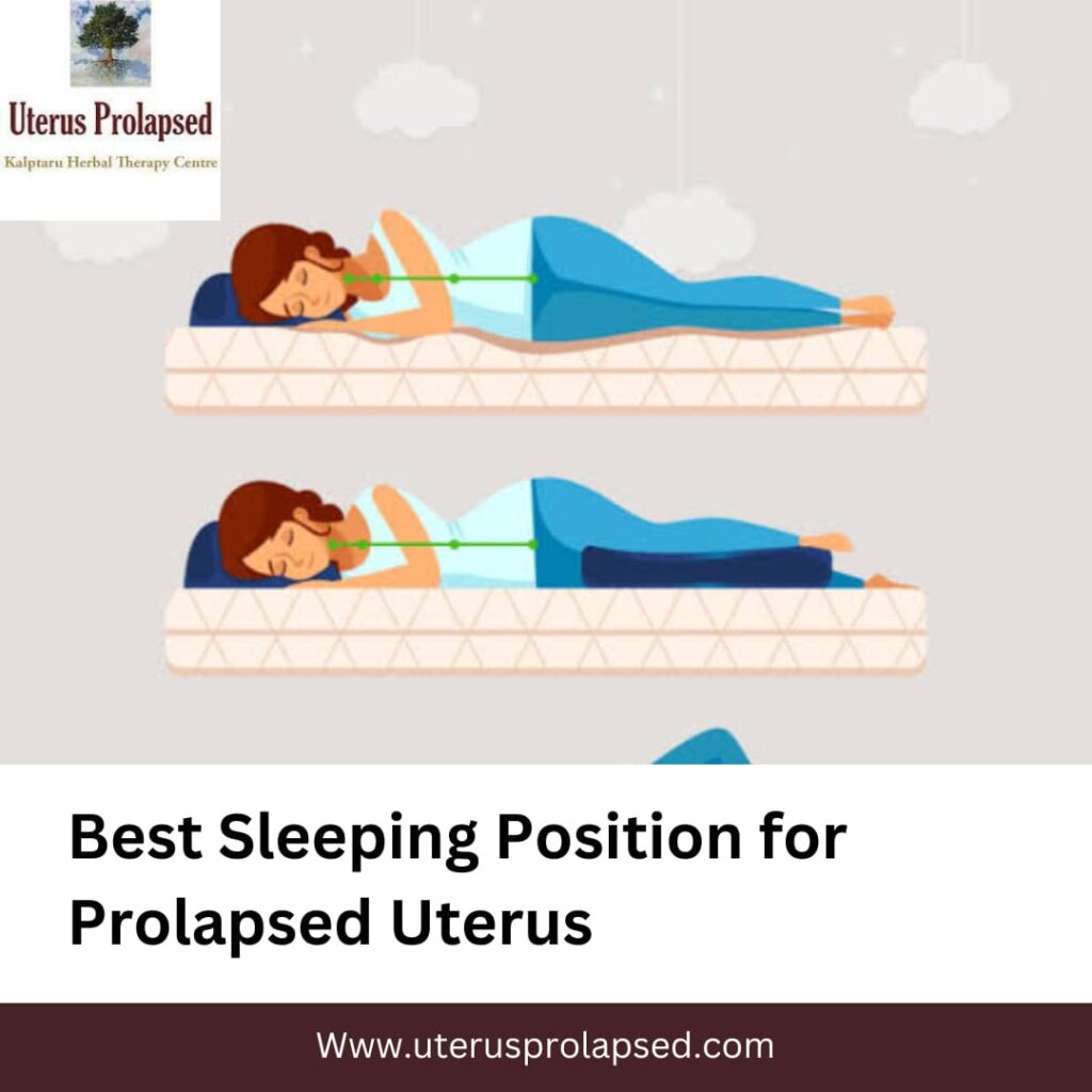 Sleeping Position for Prolapsed Uterus