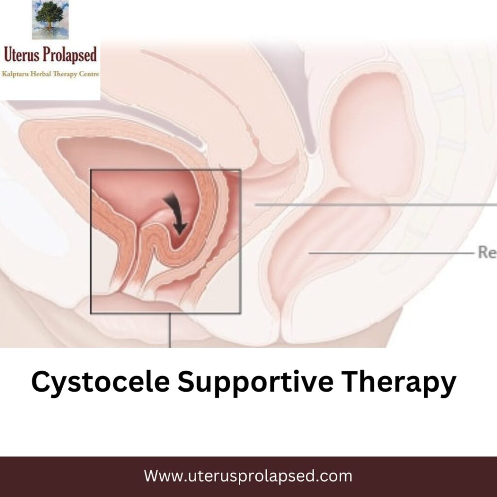 Cystocele Supportive Therapy