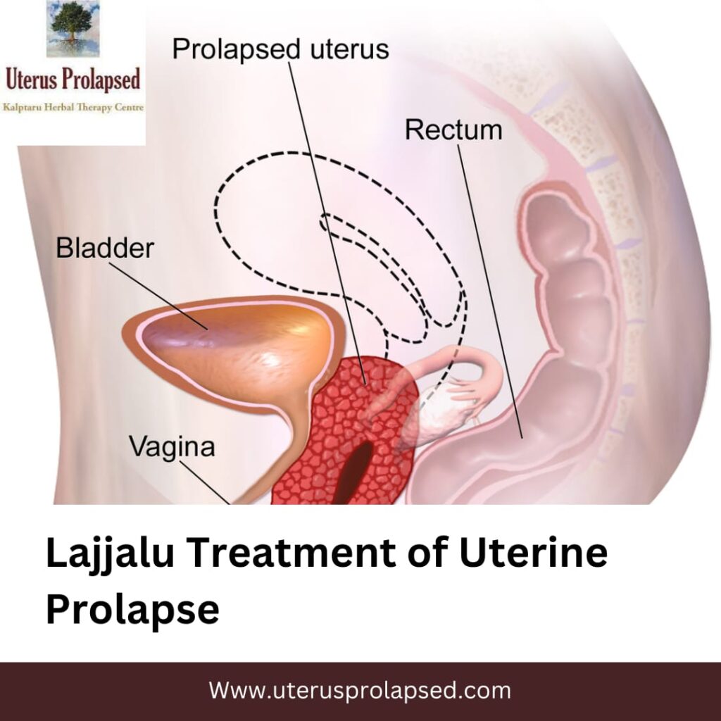 Lajjalu Treatment of Uterine Prolapse