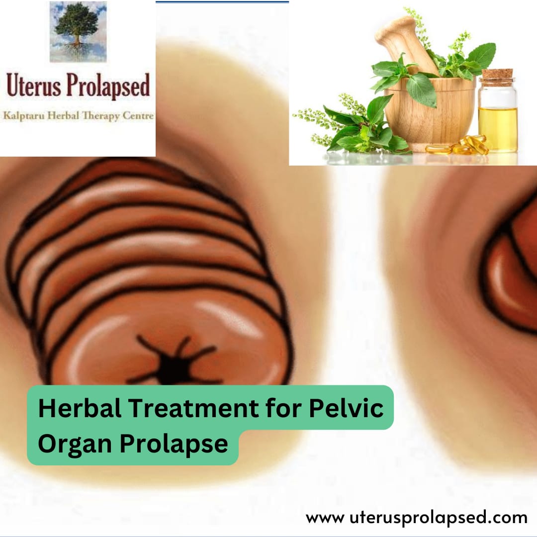 Herbal Treatment for Pelvic Organ Prolapse