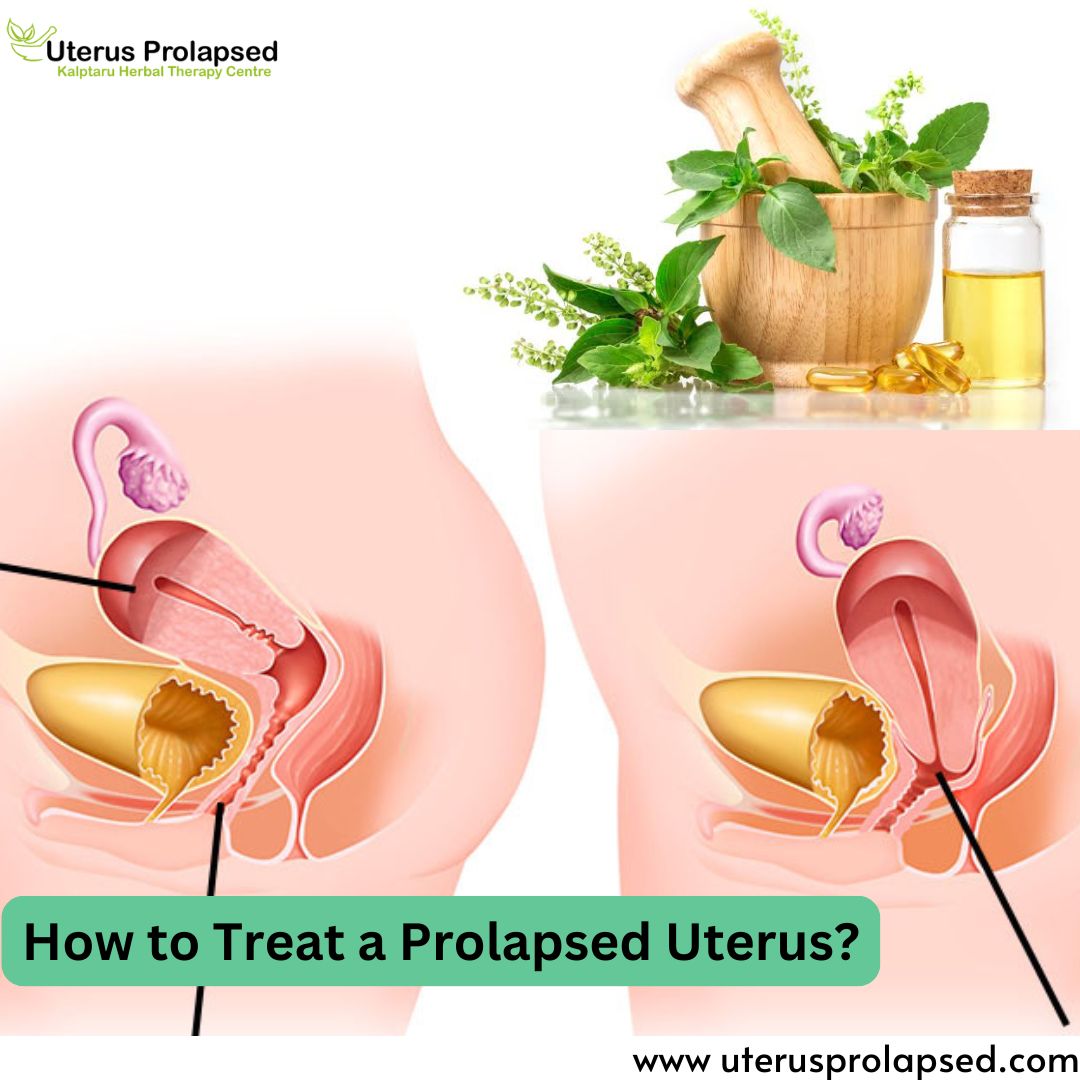 How to Treat a Prolapsed Uterus?