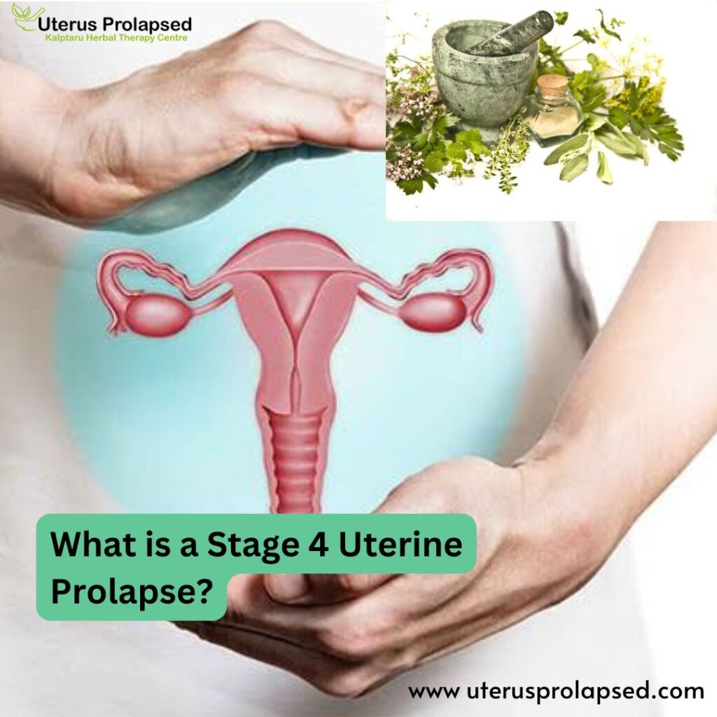 What is a Stage 4 Uterine Prolapse?