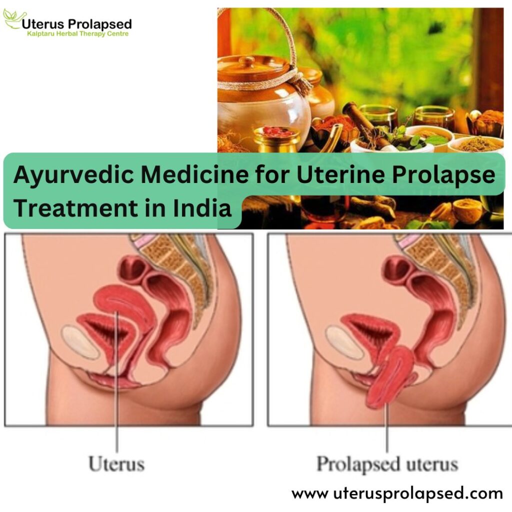 Ayurvedic Medicine for Uterine Prolapse Treatment in India