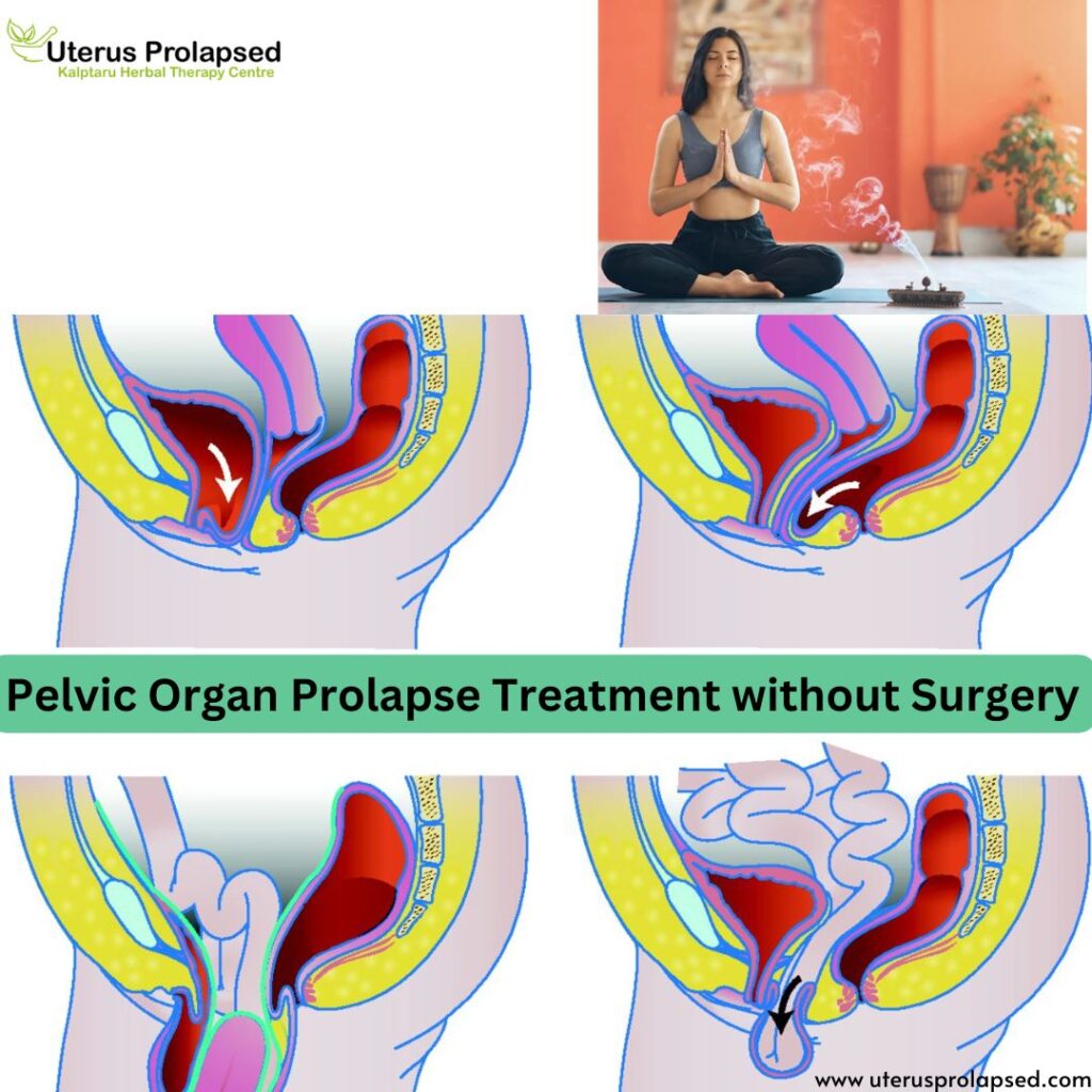 Pelvic Organ Prolapse Treatment Without Surgery