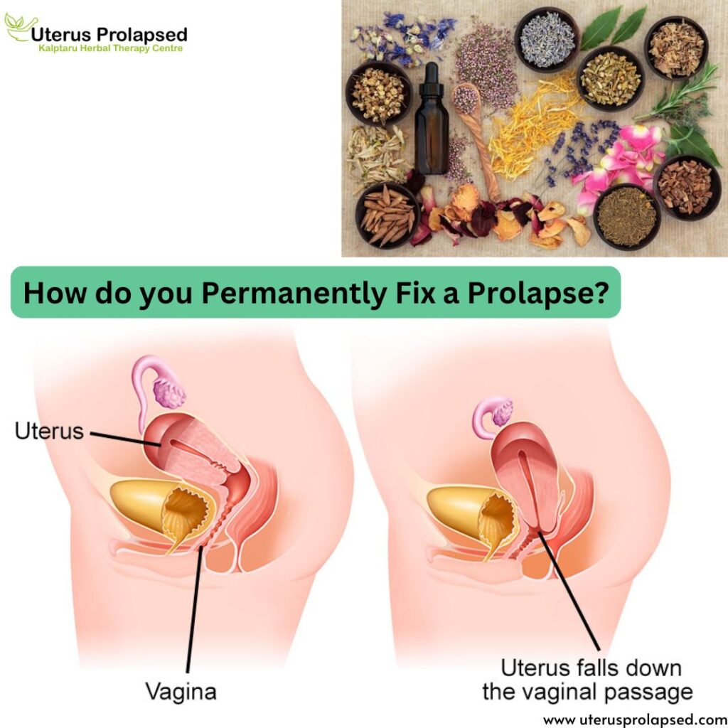 How Do You Permanently Fix a Prolapse?