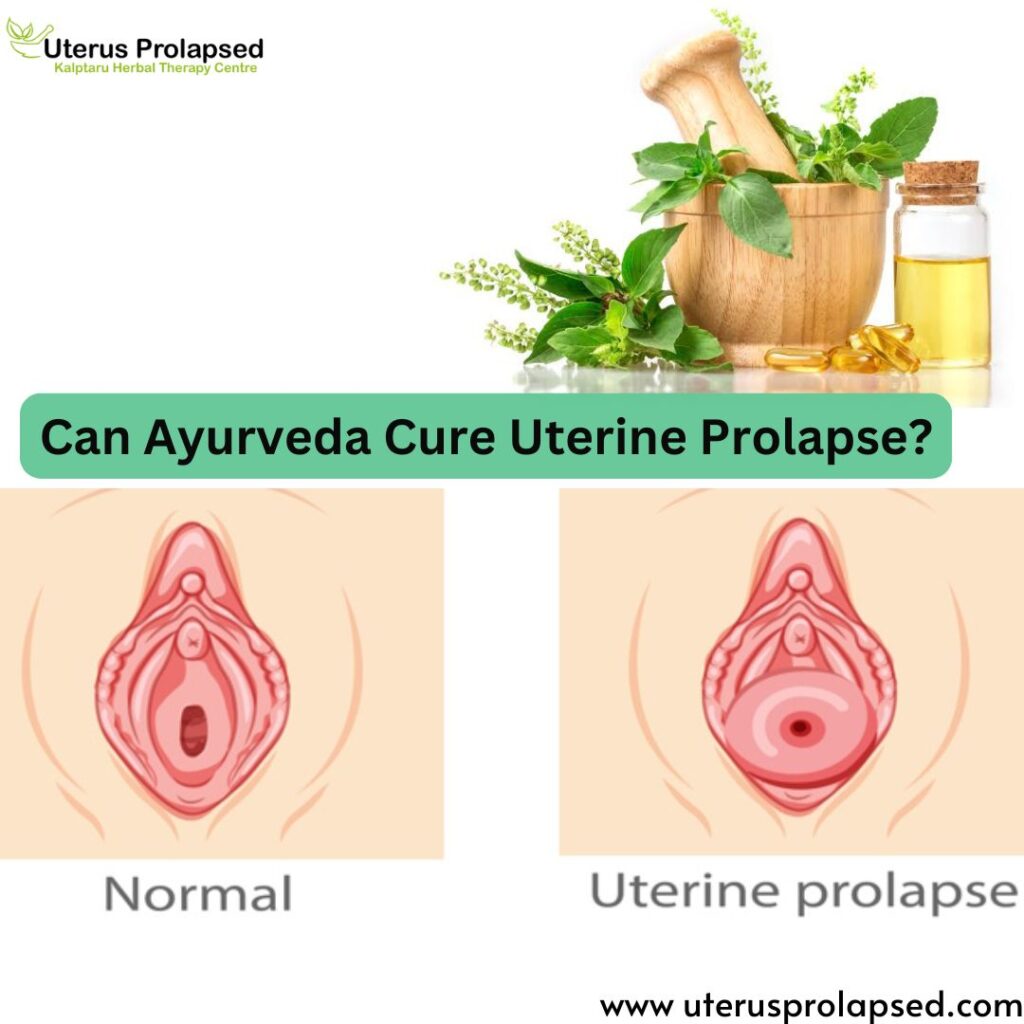 Can Ayurveda Cure Uterine Prolapse?