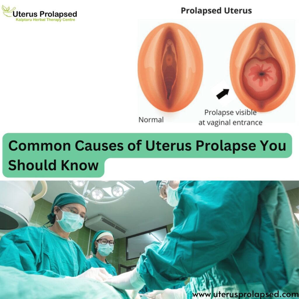 Common Causes of Uterus Prolapse You Should Know