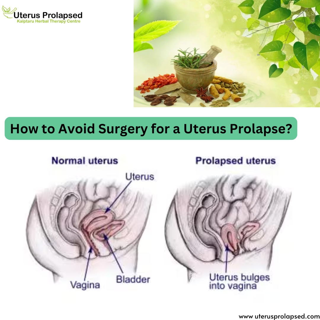 How to Avoid Surgery for a Uterus Prolapse?