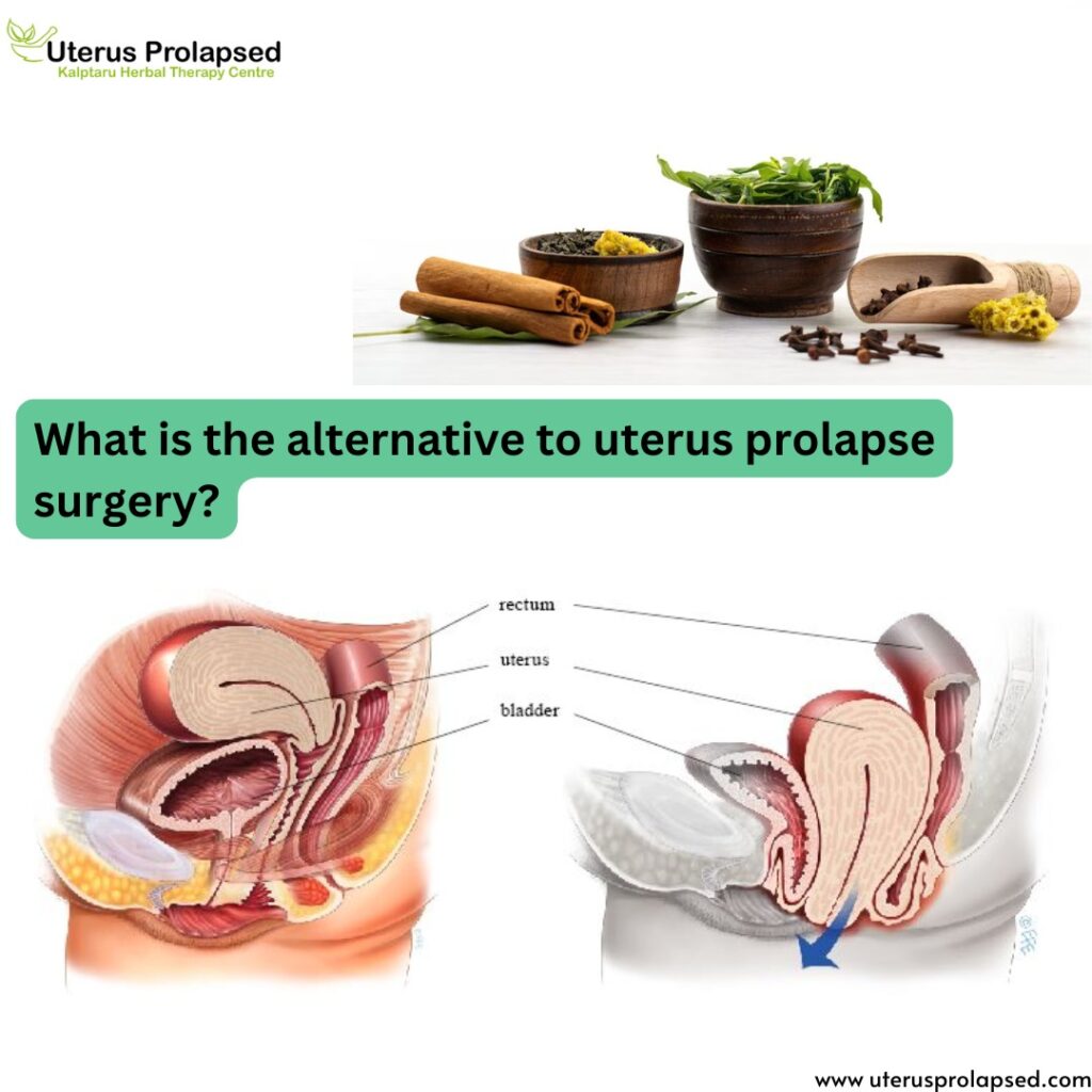 What Is the Alternative to Uterus Prolapse Surgery?