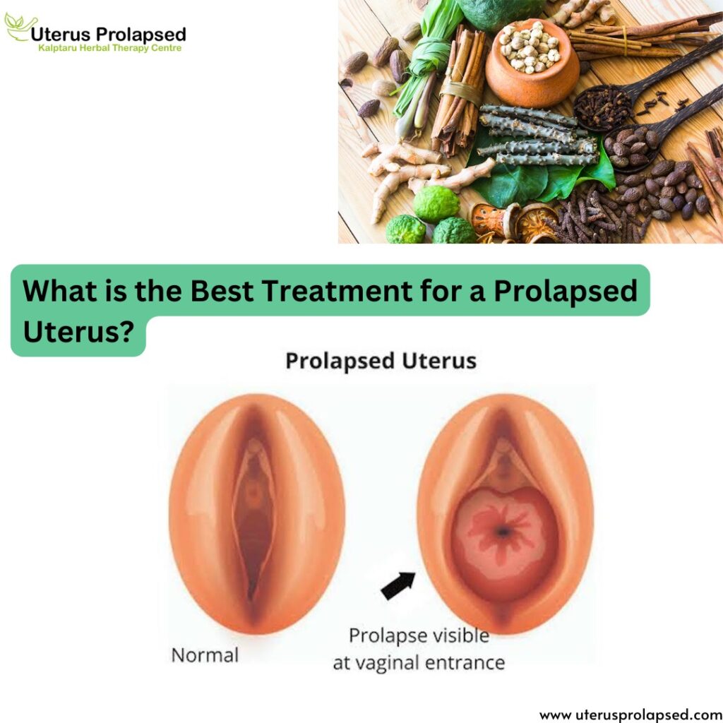 What Is the Best Treatment for a Prolapsed Uterus?