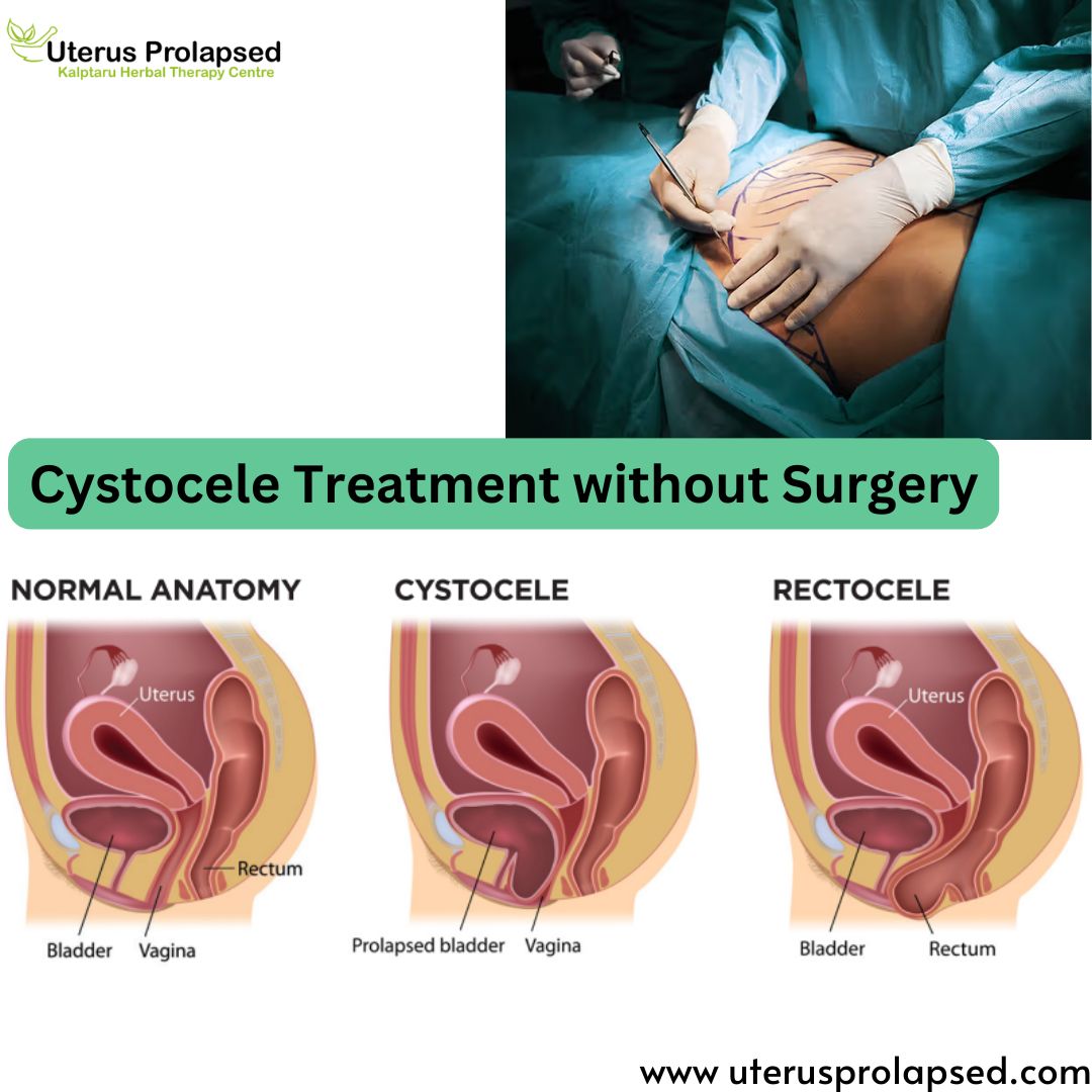 Cystocele Treatment Without Surgery