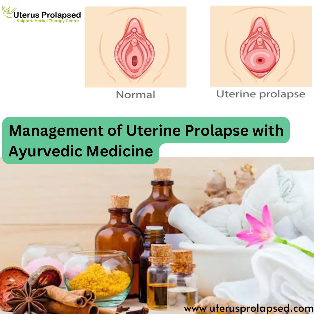 Management of Uterine Prolapse With Ayurvedic Medicine