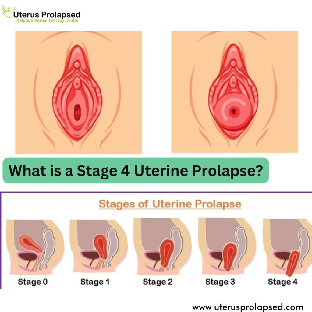 What Is a Stage 4 Uterine Prolapse?