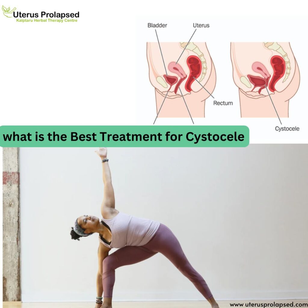 What Is the Best Treatment for Cystocele?