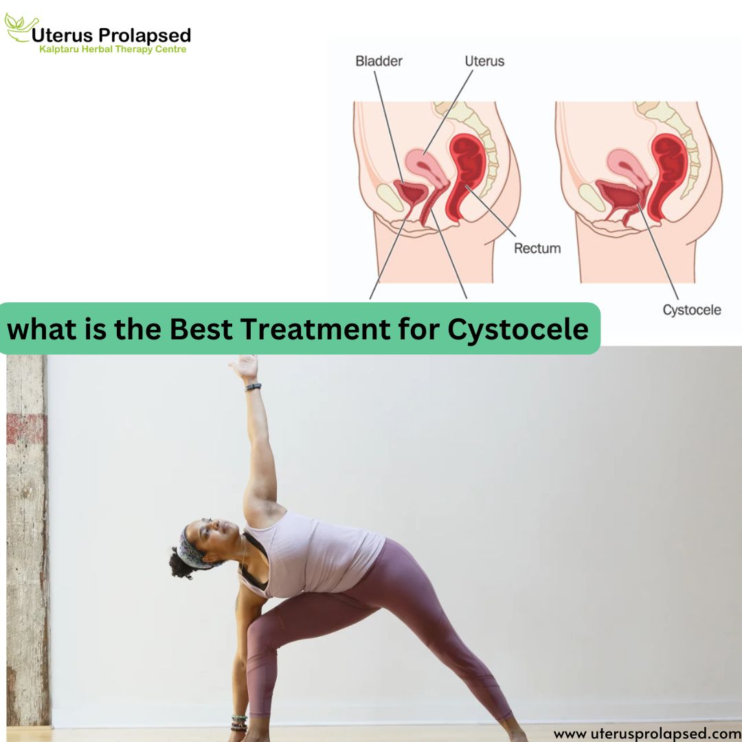 What Is the Best Treatment for Cystocele?