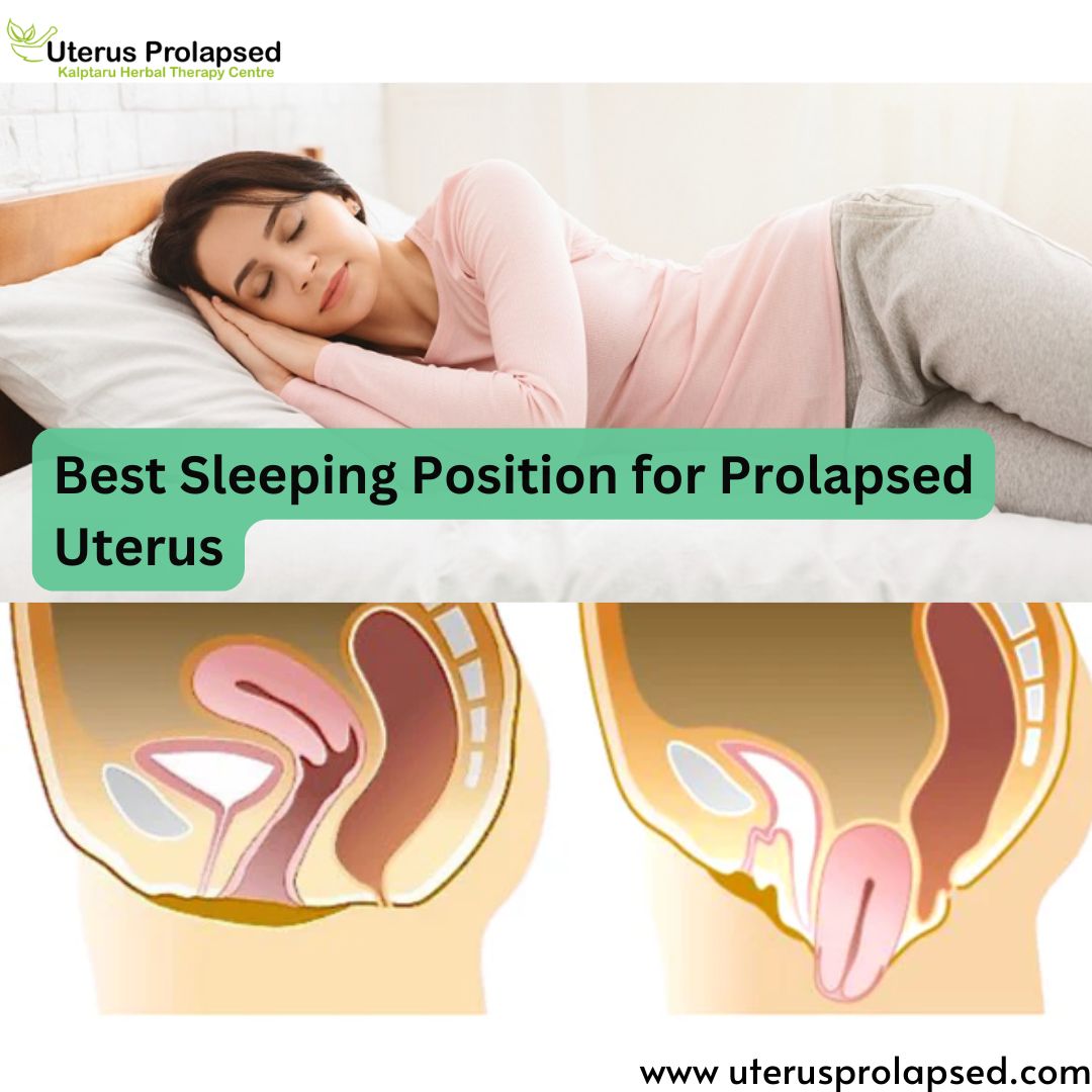 Best Sleeping Position for Prolapsed Uterus