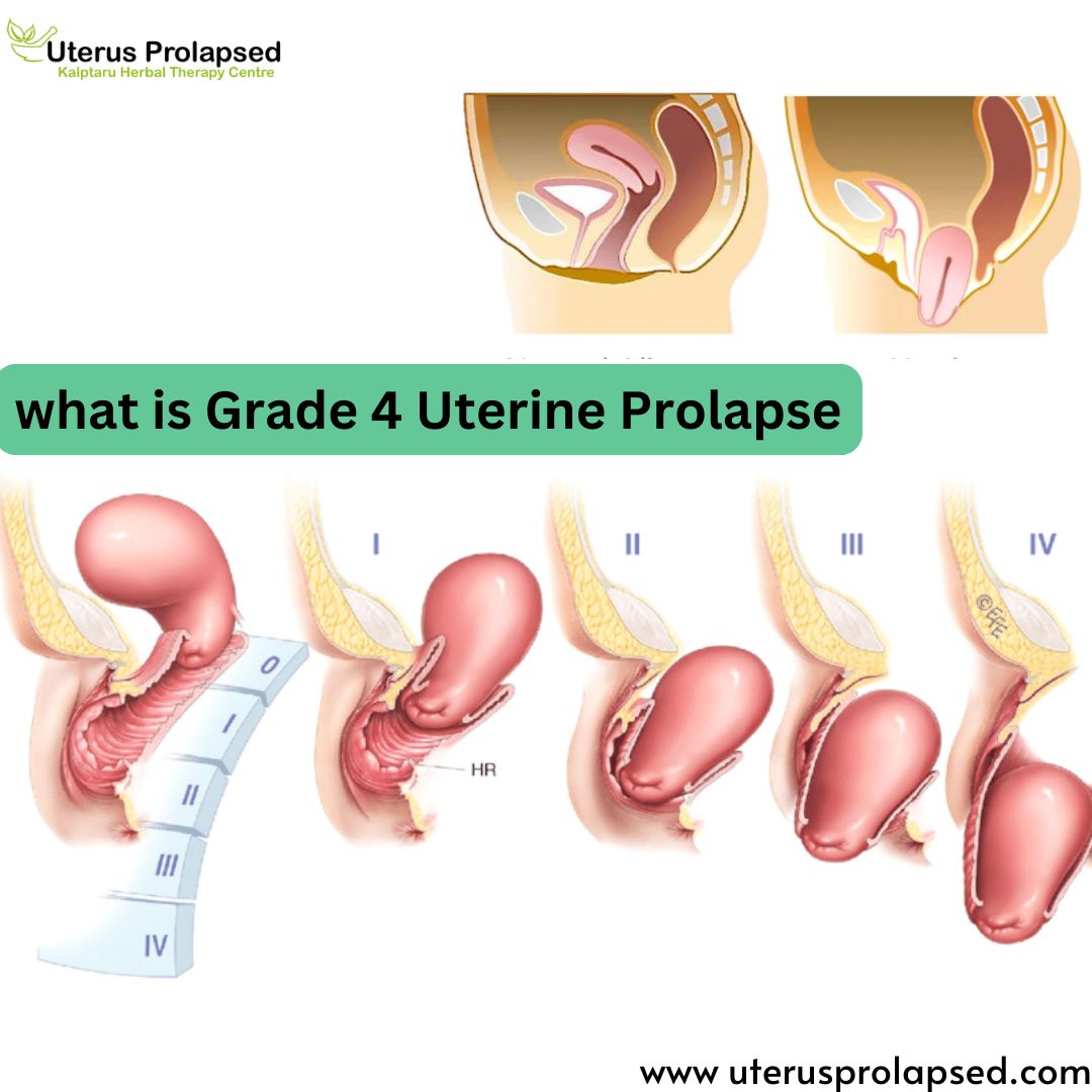 What Is Grade 4 Uterine Prolapse?