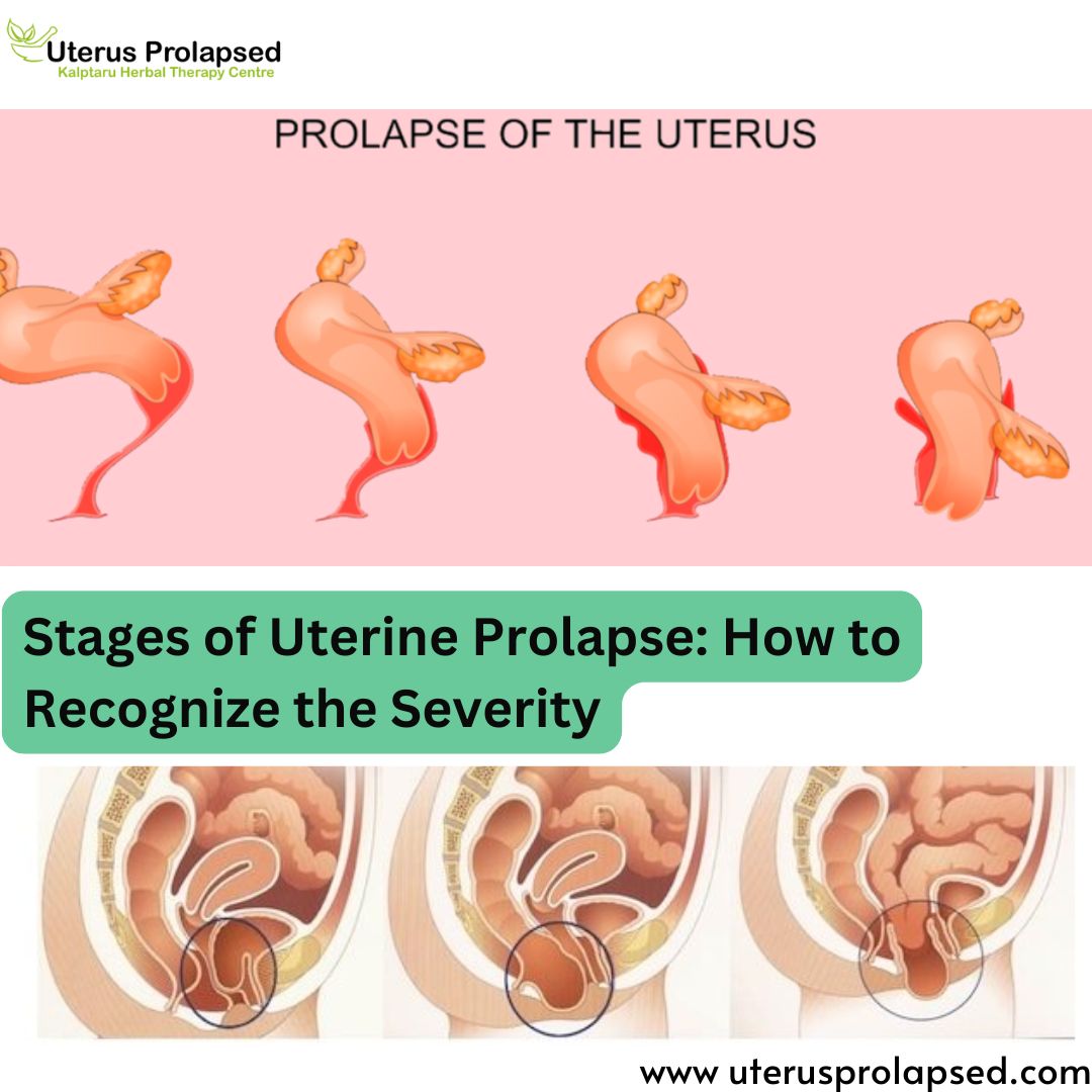 Stages Of Uterine Prolapse: How to Recognize the Severity?