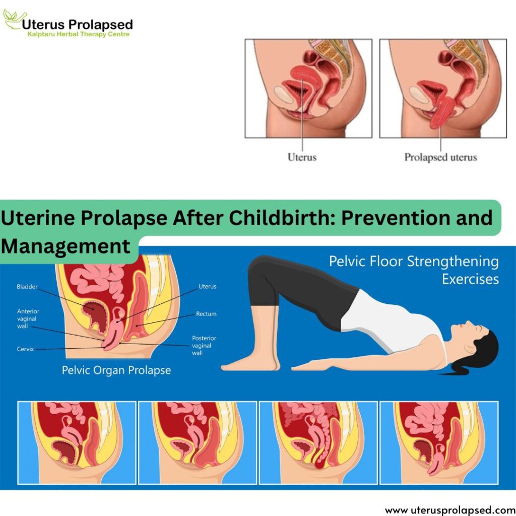 Uterine Prolapse After Childbirth: Prevention and Management