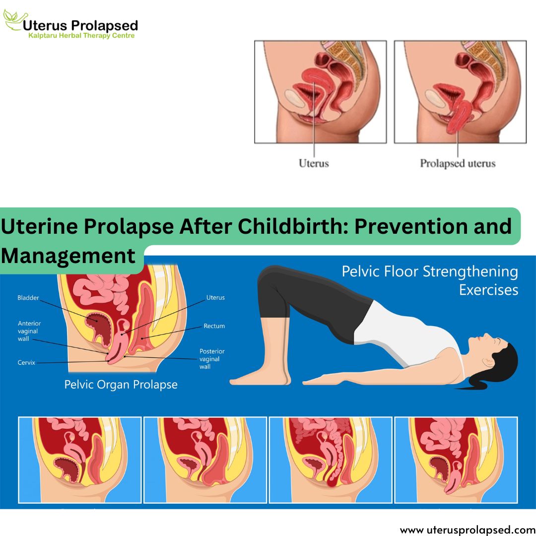 Uterine Prolapse After Childbirth: Prevention and Management