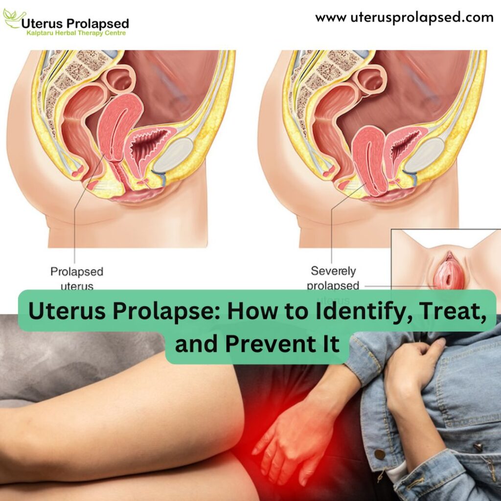 Uterus Prolapse: How to Identify, Treat, and Prevent It
