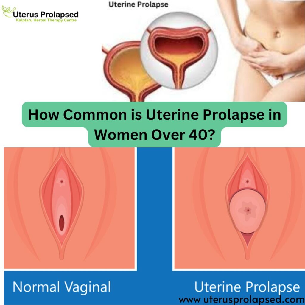 How Common is Uterine Prolapse in Women Over 40?