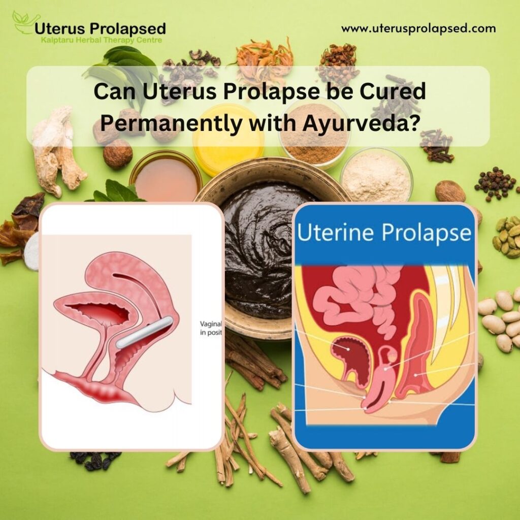 Can Uterus Prolapse Be Cured Permanently with Ayurveda?