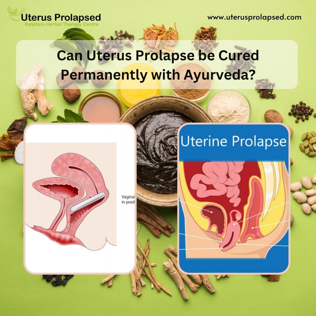 Can Uterus Prolapse Be Cured Permanently with Ayurveda?