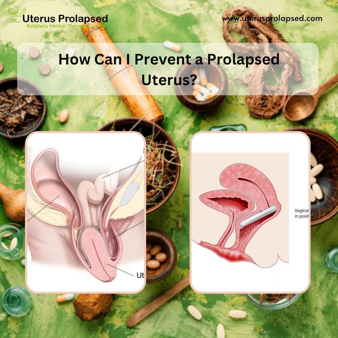 How Can I Prevent a Prolapsed Uterus?