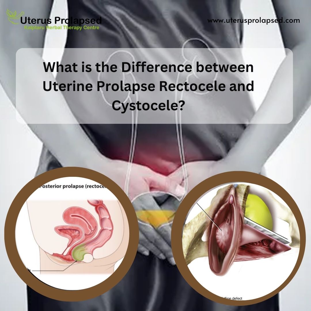What Is the Difference Between Uterine Prolapse, Rectocele, and Cystocele?