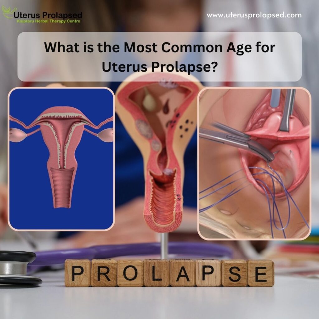 What Is the Most Common Age for Uterus Prolapse?